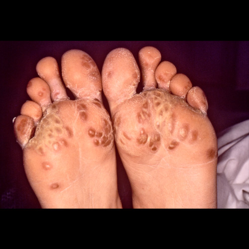 Sindrome di Reiter. Cheratoderma